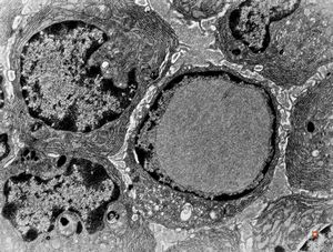 nuclear pseudoinclusion in plasmocyte